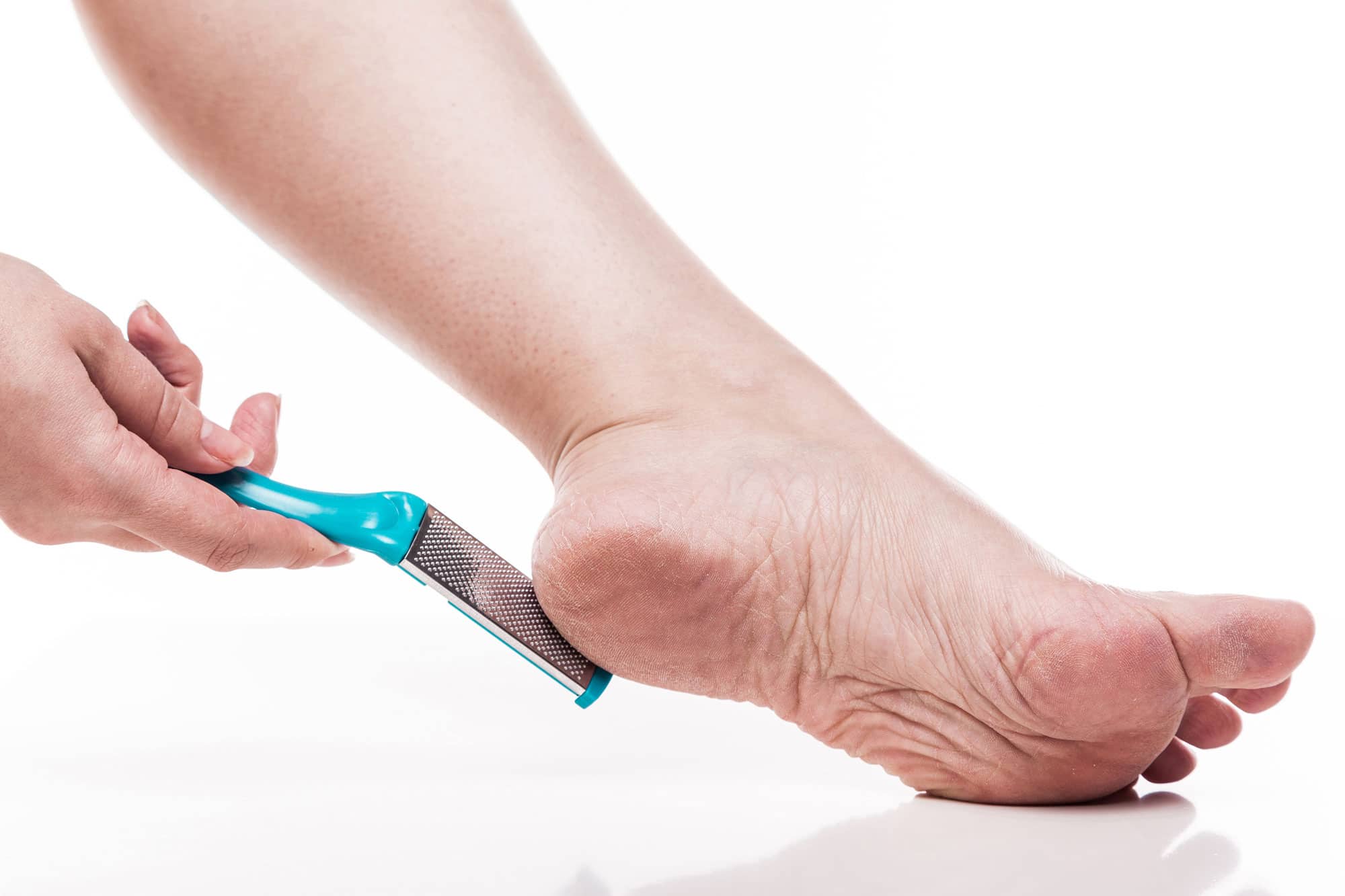 Plantar callus removal: how to get rid of calluses on feet