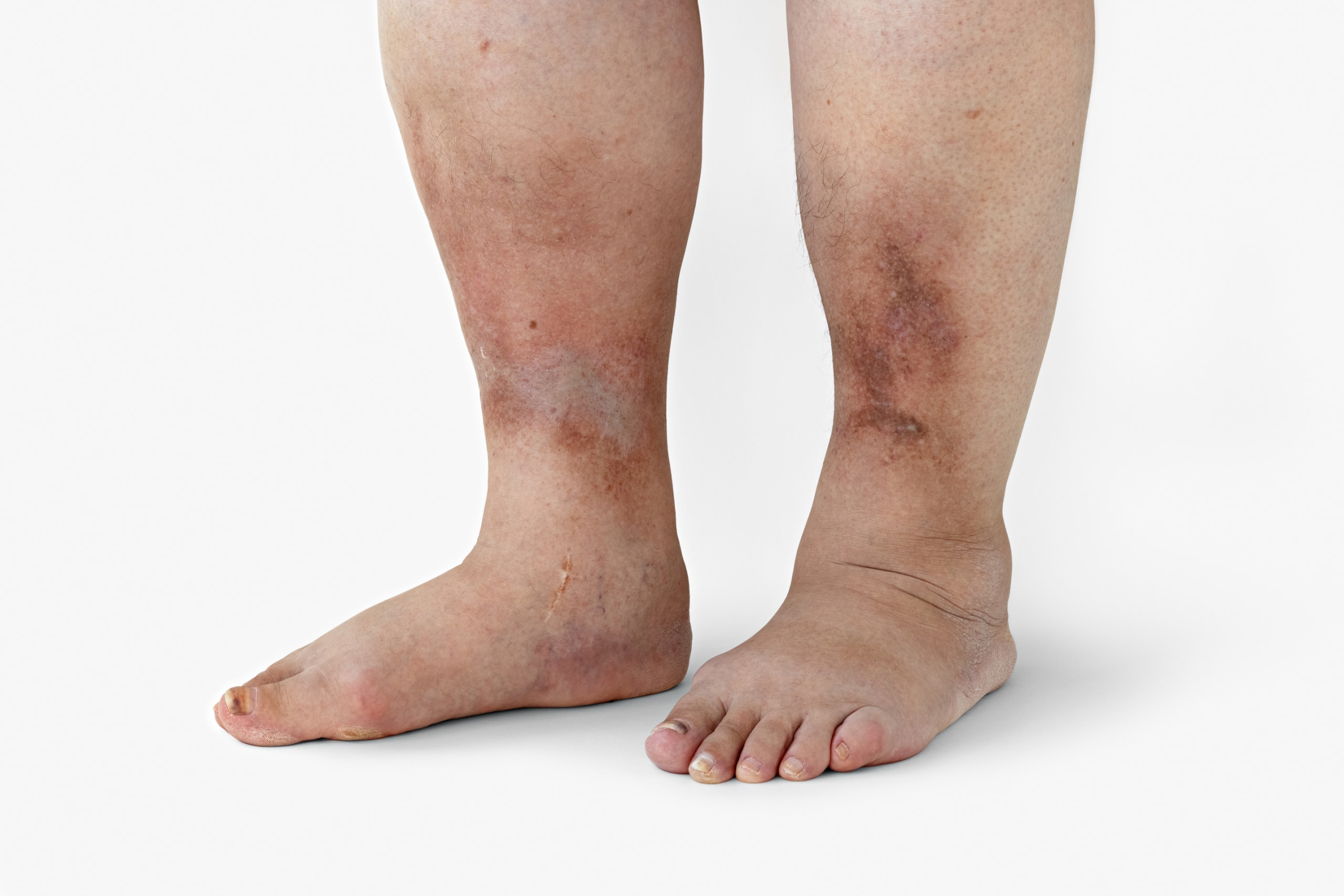 Foot, leg, and ankle swelling Information