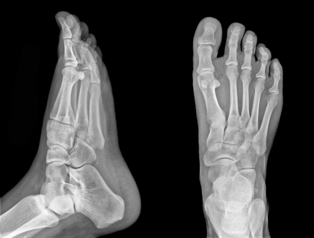 Heel Pain Austin