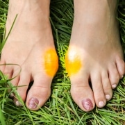 Bunion on the woman's foot. Big toe problem.