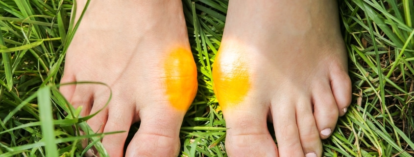 Bunion on the woman's foot. Big toe problem.