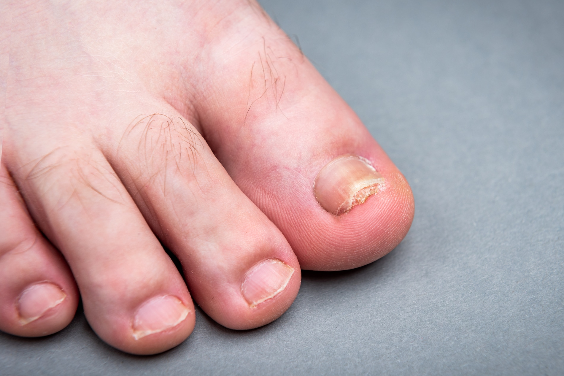 Fungal toenail treatment in Australia - Clear Step Podiatry