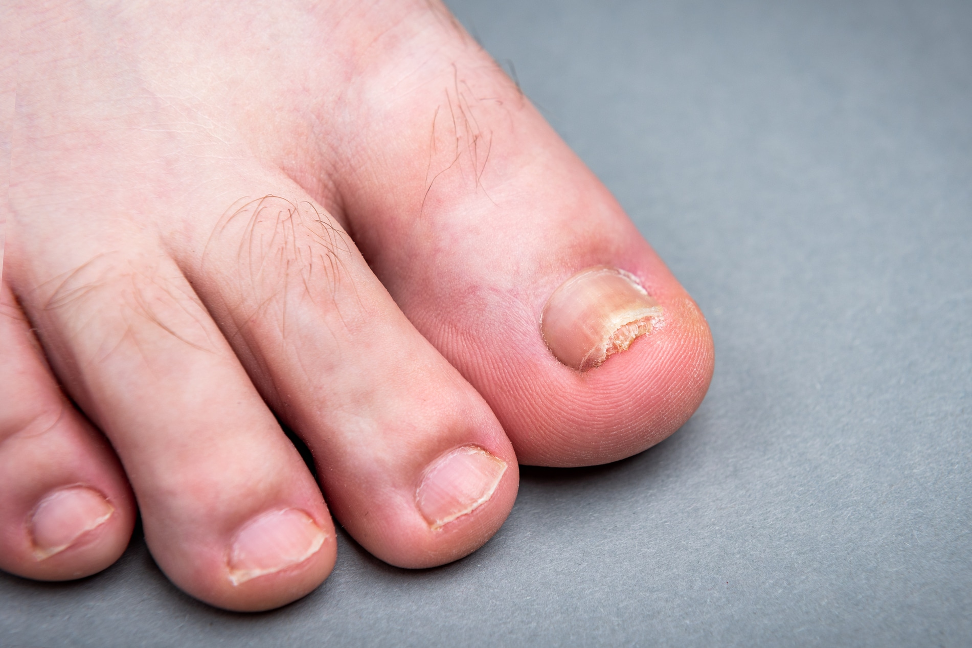 Buy MGEELHOE Finger & Toe Nail Fungus care Gel 15ml Online at Low Prices in  India - Amazon.in