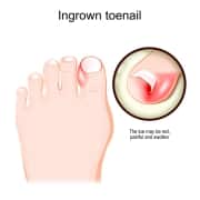 Ingrown toenail. Human foot.