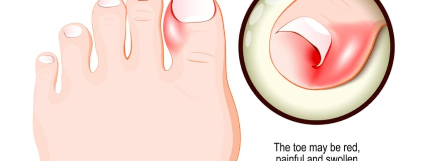 Ingrown toenail. Human foot.