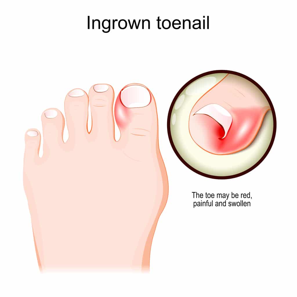 Ingrown toenail clearance warm soak