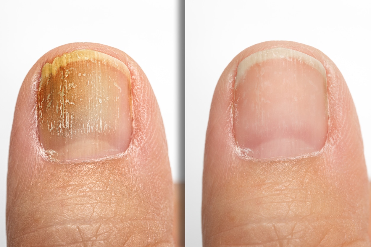 SAFELY TREAT TOENAIL FUNGUS AT HOME | Snakeroot Extract – DR. MARIE